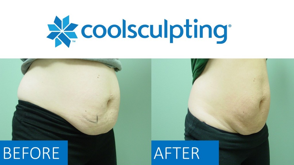 CoolSculpt2